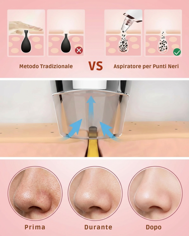 Aspiratore Professionale per Punti Neri 5 in 1